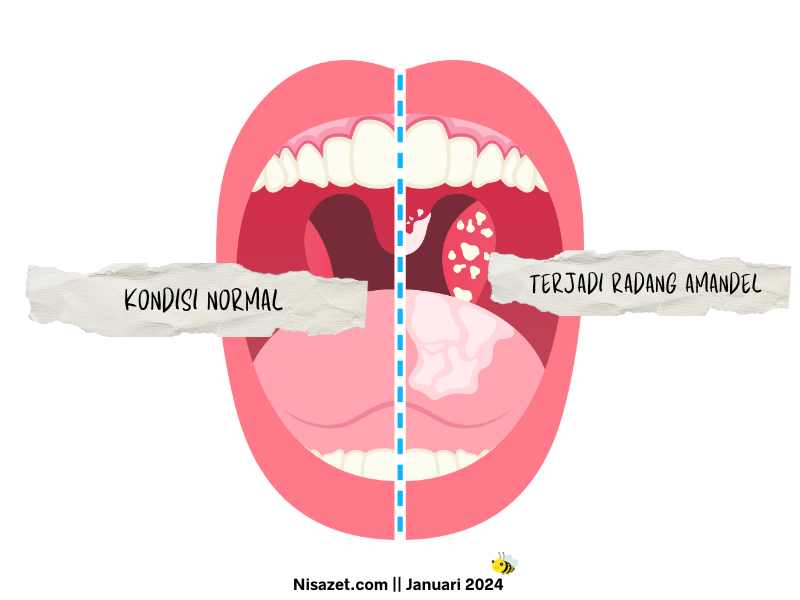 Cara pengobatan Penyakit Amandel